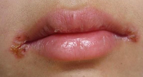 红霉素软膏可以治毛周角化症