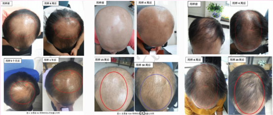 角化症用的绿色管状药膏