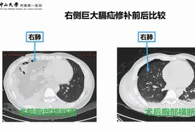 为了减掉肚腩，中年男子“用力过猛”后悲剧了：小肠、结肠等内脏“跑路”了图片