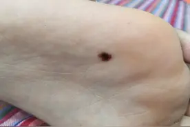 千万别大意，小孩脚底长痣最好去医院图片