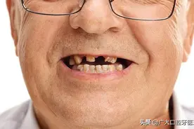烂牙残根到底要不要拔？不拔危害到底有多大？牙科专家给出答案图片
