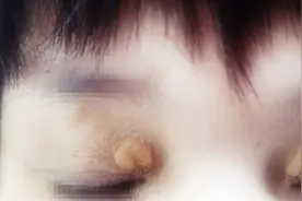 眼角长黄色肉疙瘩，是怎么回事？医生提醒：可能血脂有异常！图片