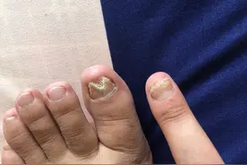 几年的灰指甲彻底好了图片