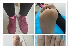这个脚痛患者，怎么诊断？怎么处理？图片