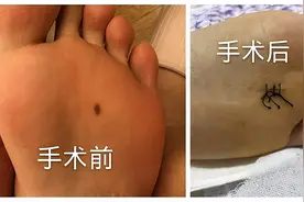 脚底突然长了颗黑痣，会癌变吗？医生：需尽快手术切除图片