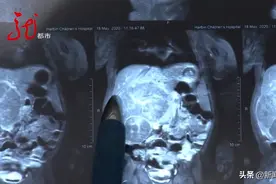 黑龙江一10月大男婴腹中长巨大肿瘤！医生：百万分之一的发病率！图片