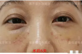 37岁小姐姐分享：眼袋消失后，卧蚕开始尽情展现魅力图片