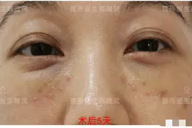 37岁小姐姐分享：眼袋消失后，卧蚕开始尽情展现魅力图片