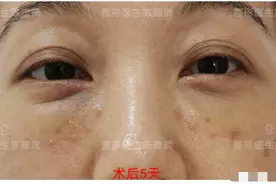 37岁小姐姐分享：眼袋消失后，卧蚕开始尽情展现魅力图片