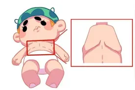 娃肋骨外翻，家长马上想到缺钙、佝偻病！医生：大都没事图片