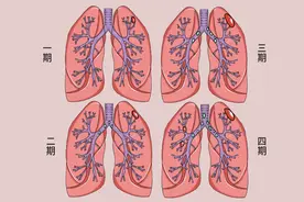 身患肺癌医生预测寿命只剩3月，但她如今已痊愈，2件事帮了大忙图片