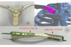 新型胸锁关节钩状板的研发与生物力学测定图片