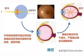 雾视疗法在近视防控中的作用图片