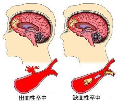 脑卒中的读音和解释（脑卒中）