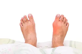 尿酸高到多少会痛风？如何判断是不是痛风？为你分享专业诊断标准图片
