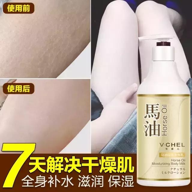 银屑病能用什么身体乳