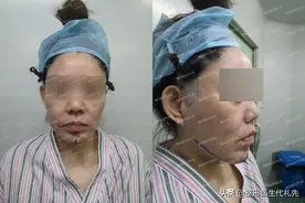 50岁左右作为在北京做过拉皮手术的过来人，谈谈我的术后感受图片