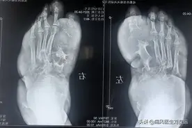 对不起！您的痛风石切除手术我不敢做，您也不愿意做图片