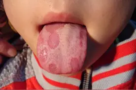 宝宝食欲不振？可能是患上了“地图舌”图片