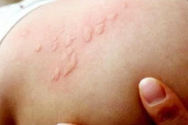 两个半月宝宝起鸡皮疙瘩