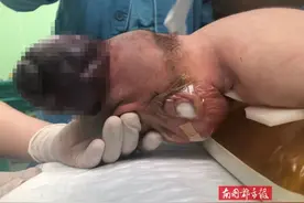 心疼！琼中一宝宝出生头上长个“大包”，妈妈孕期只做两次产检图片