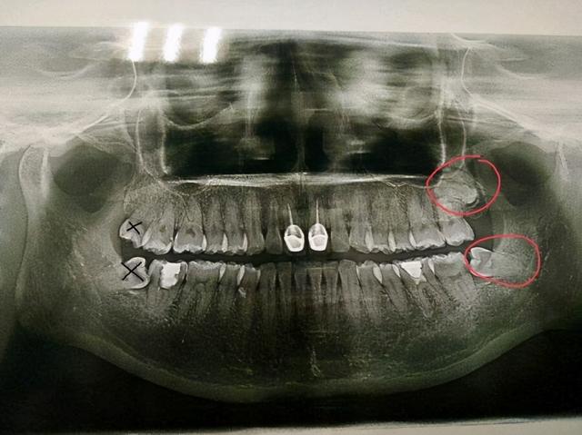 立事牙多少钱一颗,拔个智齿需要多少钱 - 冷求网