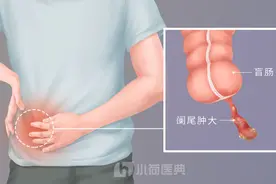 阑尾炎的疼痛位置在哪里？图片