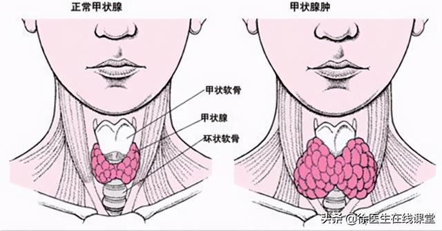 双侧甲状腺多发胶质结节 双侧甲状腺多发胶质结节2类