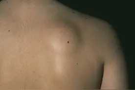 不可忽视的“脂肪瘤”图片