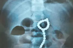 4岁女孩吞下26颗磁力珠，肠道竟被磨穿6个洞图片