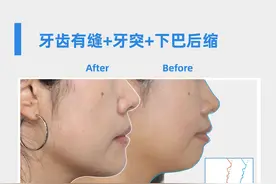 戴过牙套（矫正牙齿）的人脸型都变了吗？图片