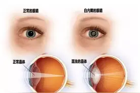 哪些因素会导致早发白内障？图片