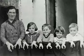 可恨又可悲的“龙虾男孩”：一生背负畸形诅咒，结局令人唏嘘图片