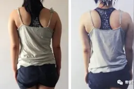 脊柱侧弯有多恐怖？赶紧来看看！看完记得赶快自测…图片