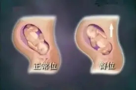 孕期臀位怎么办？图片