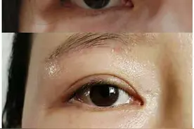 作为做过“提眉手术”的人，我告诉你几个真相图片