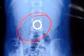 孩子因磁力珠险些胃穿孔，这种益智玩具为何如此危险？图片