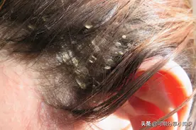 江苏一女子坚持用“硫磺皂水”洗头，三个月后，出现了哪些变化？图片