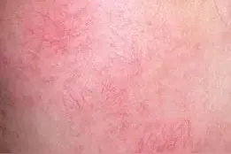 脸上长“红血丝”，医生：平时的坏习惯要纠正！图片