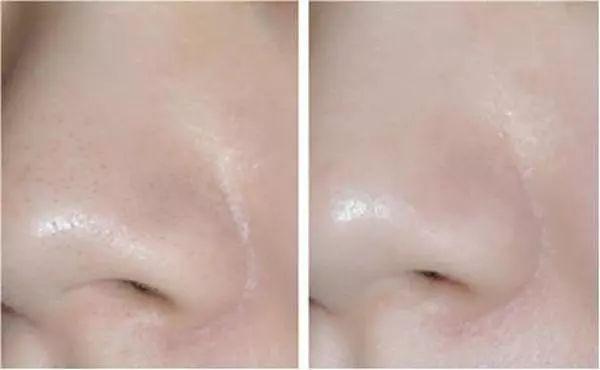 去粉刺毛囊炎痤疮鸡皮身体乳