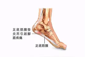 中老年人出现脚底板疼，常有3种病因，医生告诉您如何鉴别及治疗图片