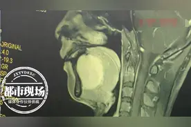 女子突然讲话不利索，竟是嘴里含了"龙珠"，有鸡蛋般大小图片