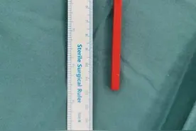 神兽在家警惕意外！3龄童摔倒筷子插颅脑，儿童医院5.5小时手术“拆弹”图片