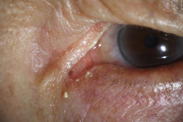 眼角化脓自己怎么处理