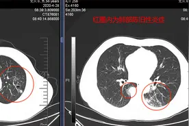 中医药联合化疗治疗肺腺癌取得奇效：肿瘤居然消失了图片