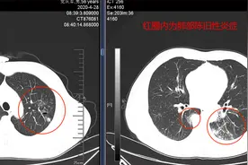中医药联合化疗治疗肺腺癌取得奇效：肿瘤居然消失了图片