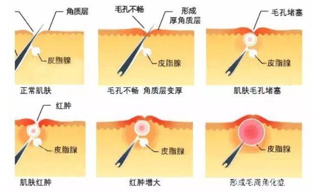 鸡皮疙瘩皮肤遗传