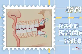 「够科普」不是每一颗智齿都要拔掉！拔智齿注意事项一次讲清图片