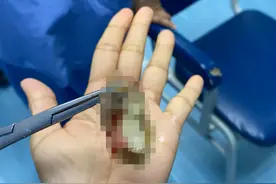 年轻病患浓痰卡喉咙进ICU，医生：冠病不是普通感冒图片