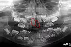 宁德7岁女孩嘴里长了两颗奇怪的新牙，医生：幸好来得及时图片
